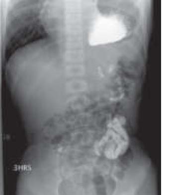 diaphragmatic rupture with contrast